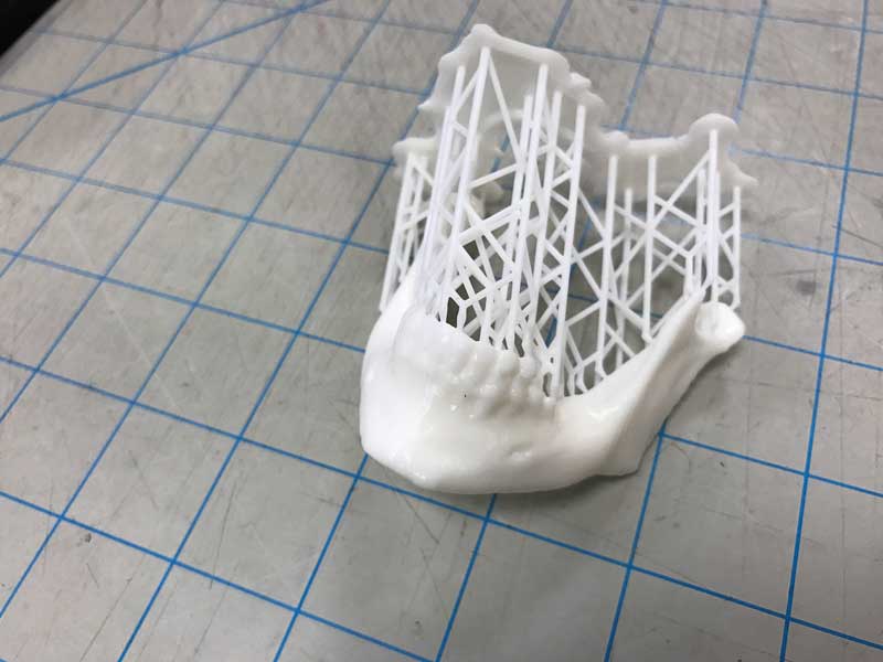 3D printed mandible from NIH