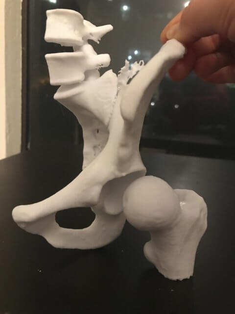 3D printed pelvis