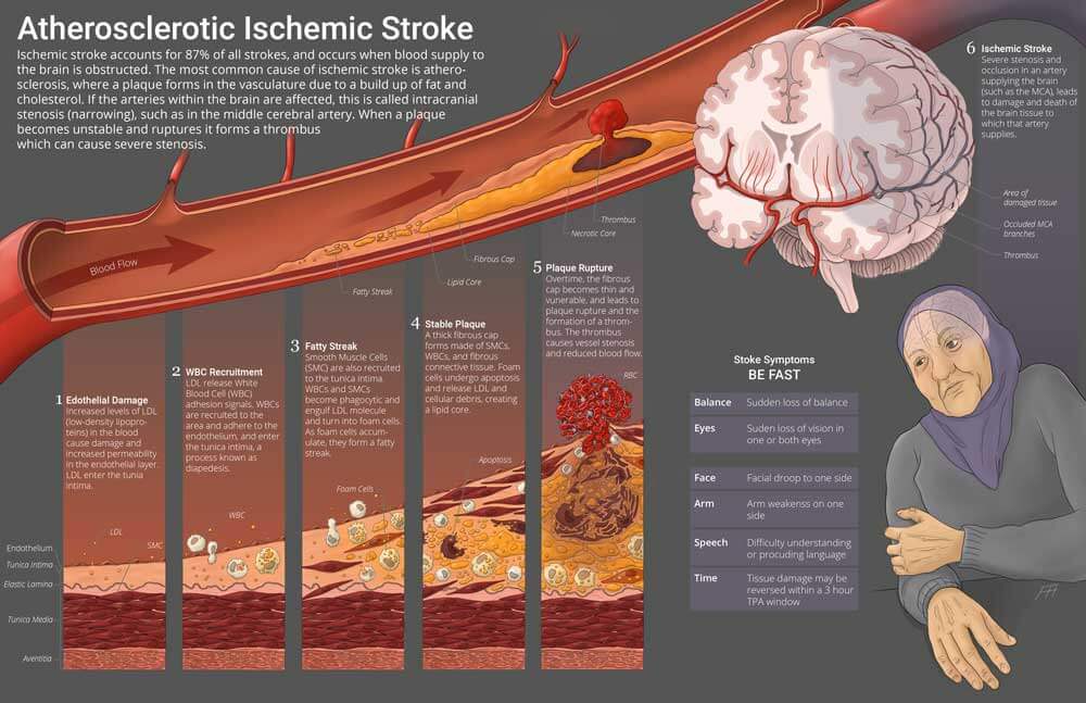 Editorial spread visualizing the pathogenesis of atherosclerosis, and how this leads to intracranial stenosis resulting in an ischemic stroke