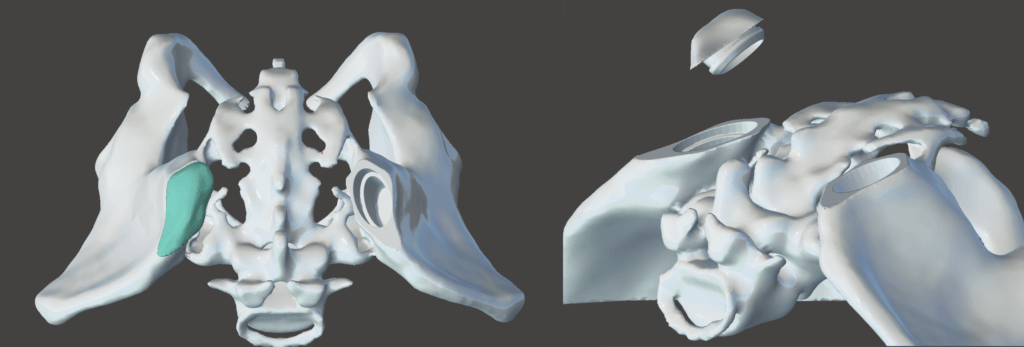 Modeling pelvis in Meshmixer