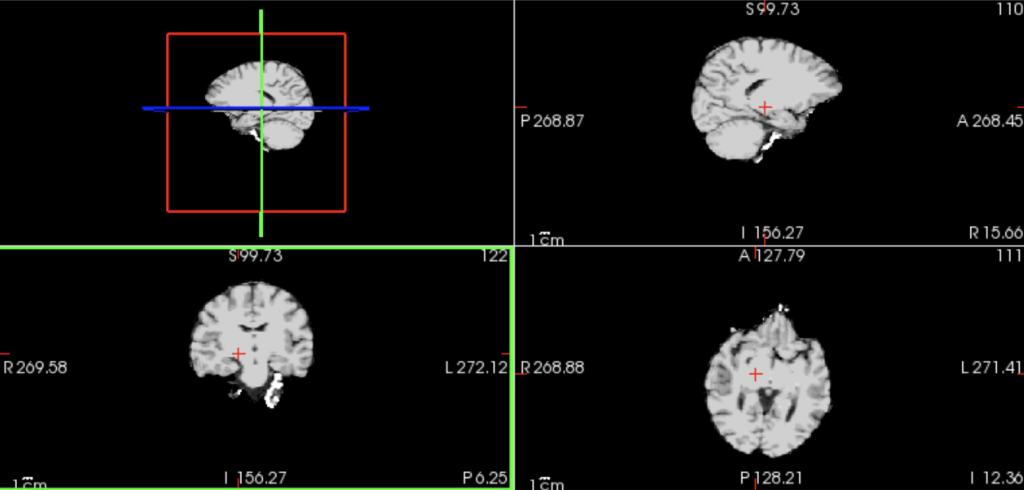 a brain MRI viewed in Freeview software