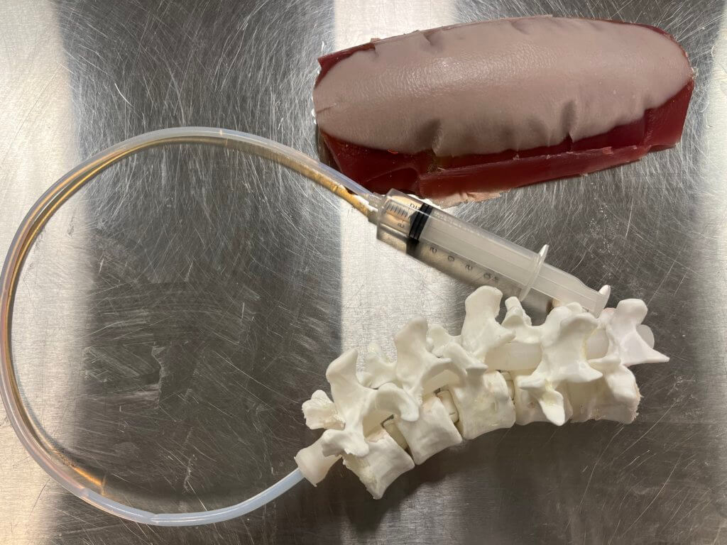 Early prototype of the lumbar puncture model with 3D printed spine, generic tubing, and lump of silicone "flesh".