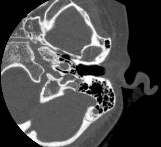 Axial cut of CT scan through temporal bone