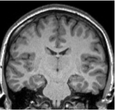 Brain scan