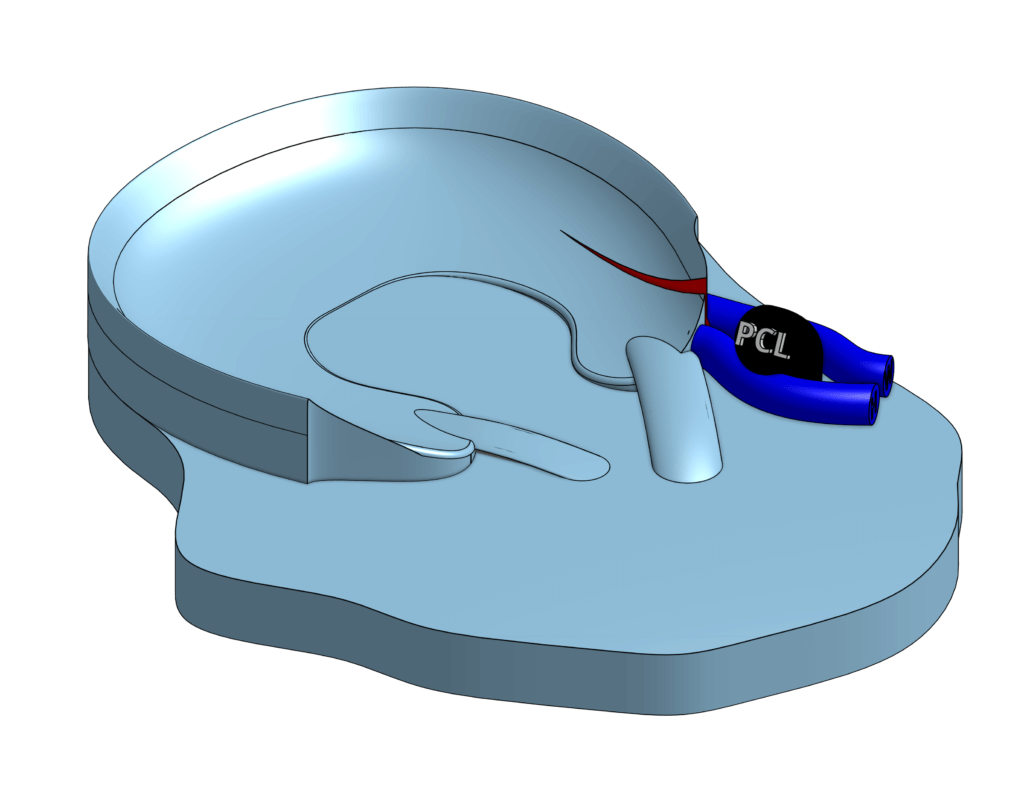 Ilan's early attempts of modeling Wrisberg rips with the posterior cruciate ligament in OnShape. The design shows the anatomical relationship of the Wrisberg and Humphry meniscofemoral ligaments (Blue) and the posterior cruciate ligament (Black; PCL) with the posterior horn of the lateral meniscus.