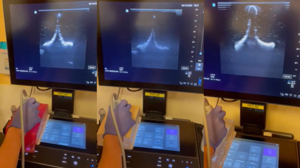 Three side-by-side photos of person with a gloved hand using ultrasound device on lumbar models with latex resistance band as skin, practice tattoo skin, and no skin. The different tests are show on a monitor.