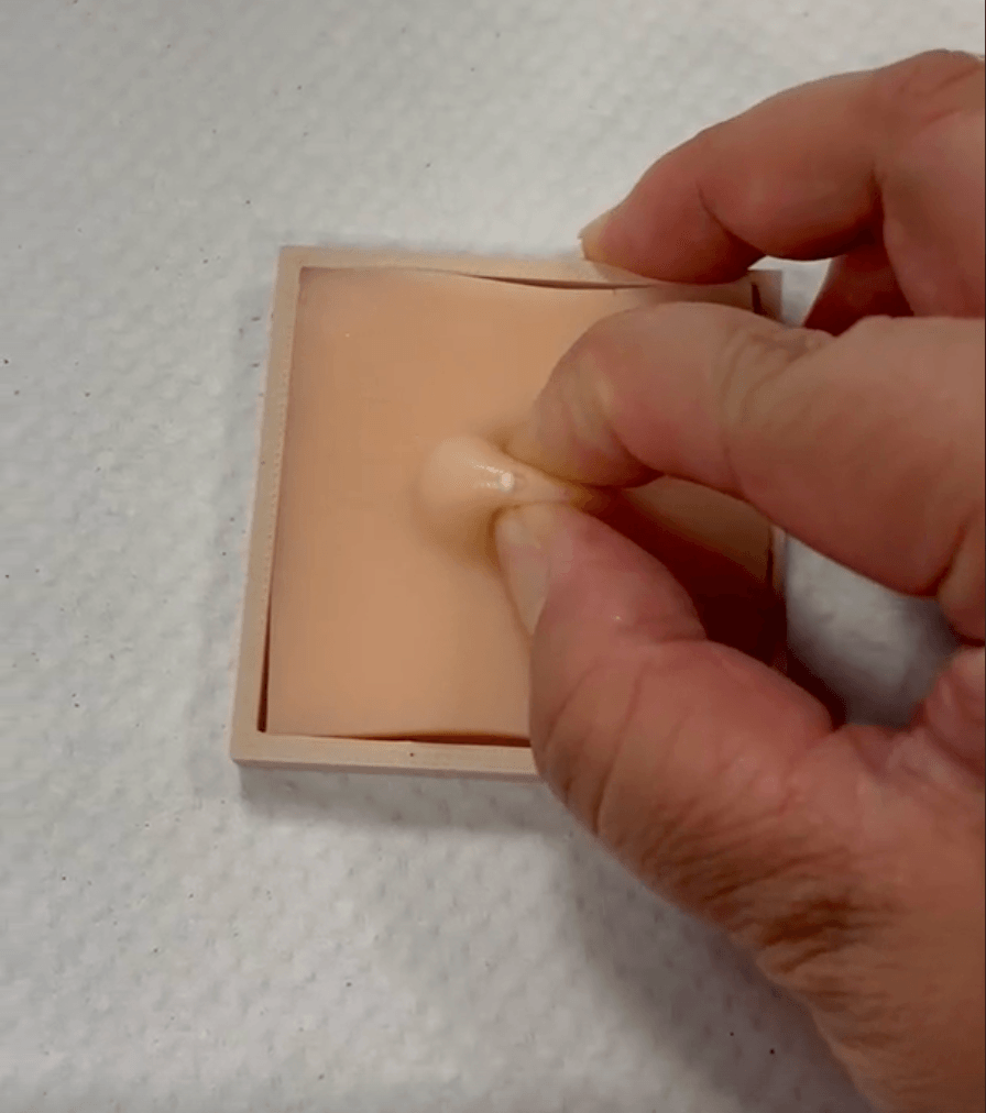 Close up of fingers pinching a silicone cyst model and squeezing out "pus" simulated by lotion.